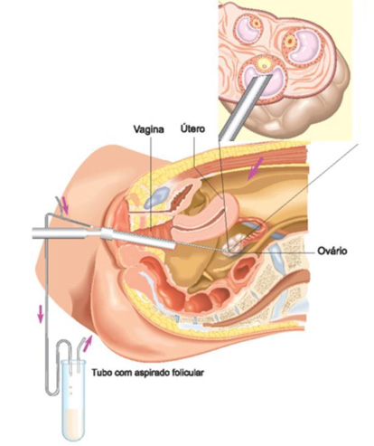 aspiracao-folicular