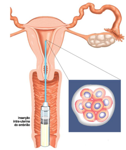 transferencia-de-embriao
